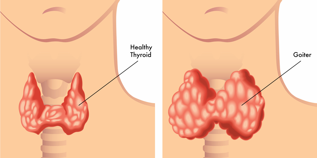 Dieta potrivită persoanelor cu tiroidectomie şi afecţiuni tiroidiene